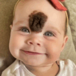 ¡Padres Remueven la Rara Marca de Nacimiento de su Bebé para Protegerla de la Crueldad! ¡Mira Cómo Luce Hoy! ¡Padres Remueven la Rara Marca de Nacimiento de su Bebé para Protegerla de la Crueldad! ¡Mira Cómo Luce Hoy!