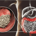 ¿Sabías que podrías tener parásitos sin saberlo? ¿Sabías que podrías tener parásitos sin saberlo?
