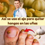 Cómo eliminar hongos de la piel, uñas, manos, pies y cuero cabelludo con ajo: el remedio natural más potente